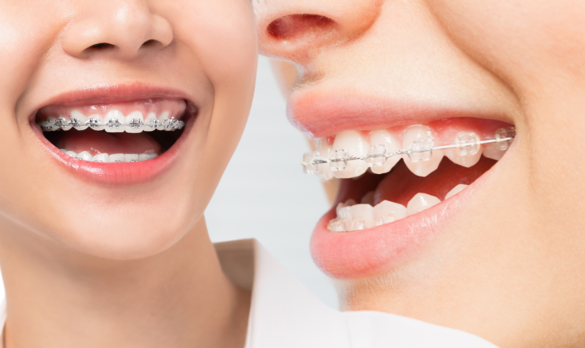 Clear Braces Compare To Traditional Braces