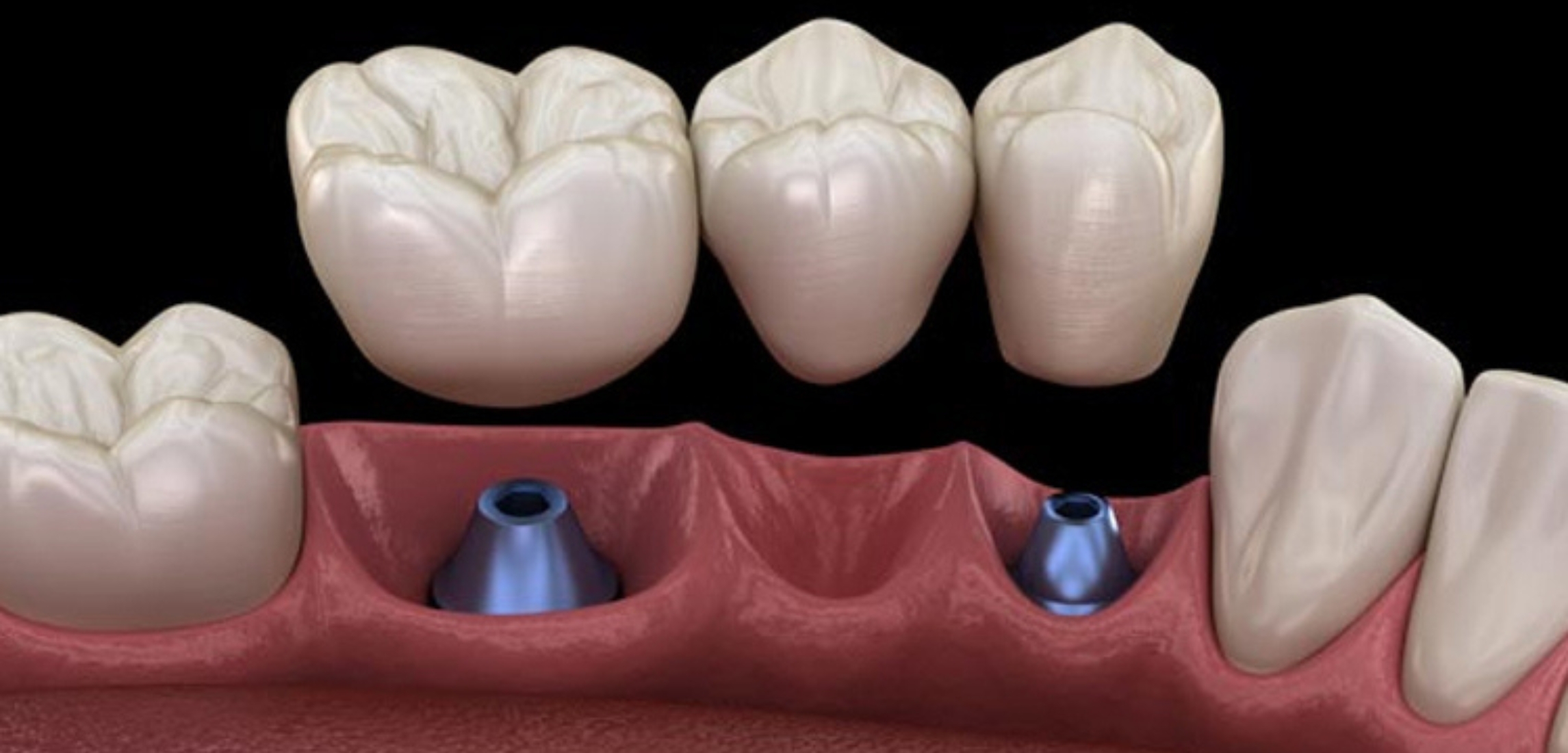 What Happens If a Dental Implant Fails During Surgery