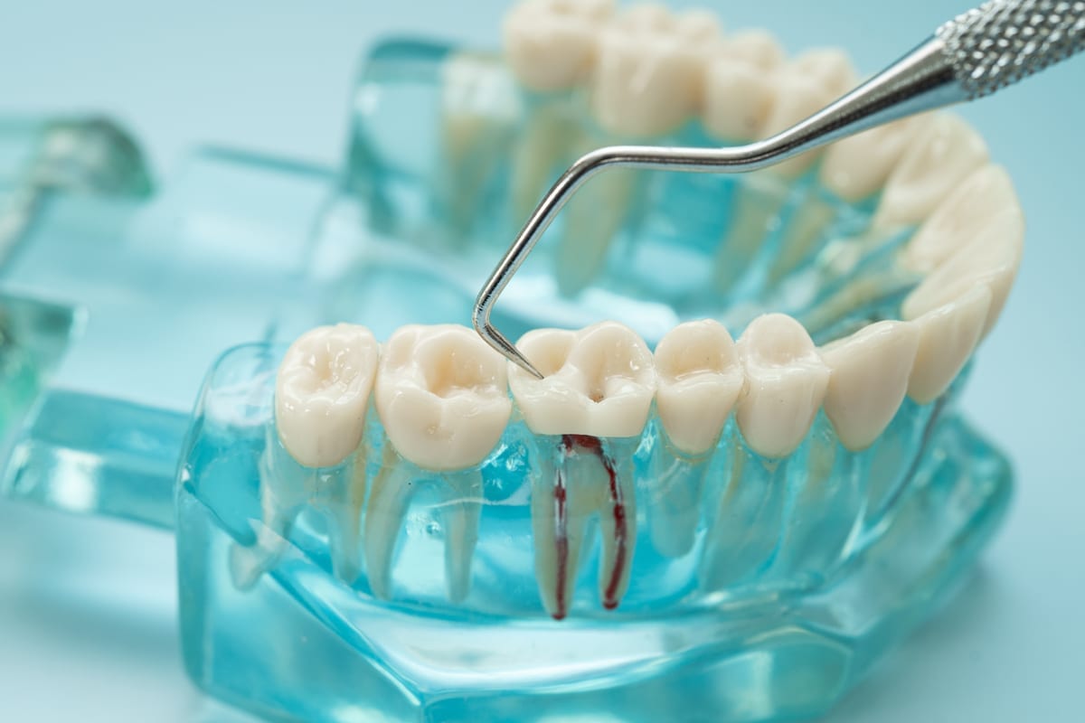 Root Canal Treatment in Morrisville